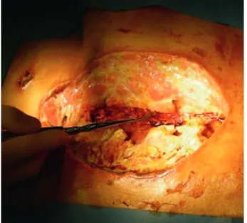 Figure 1: Preoperative aspect of the wound showing sternum diastasis and ex- ex-tensive loss of tissue.