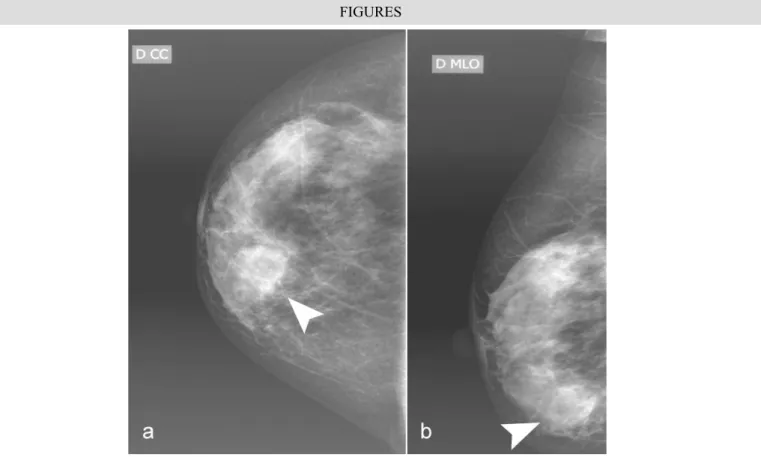 Figure  1:  77-year-old  Caucasian  woman  with  Large  B-cell  non-Hodgkin  lymphoma  of  the  right  breast