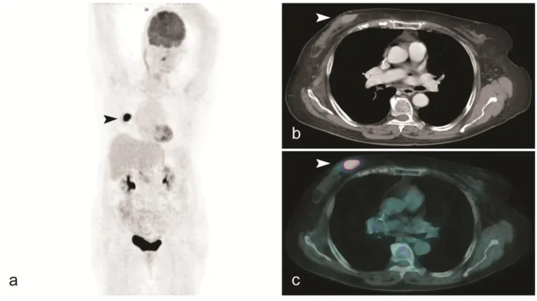 Figure  4:  77-year-old Caucasian woman with Large B-cell non-Hodgkin lymphoma of the right breast