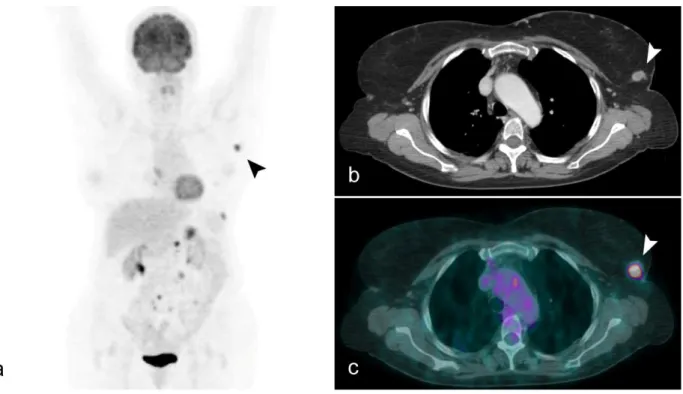 Figure 7: A 69-year-old Caucasian woman with non-Hodgkin lymphoma of the left breast. In (a) MIP of patient
