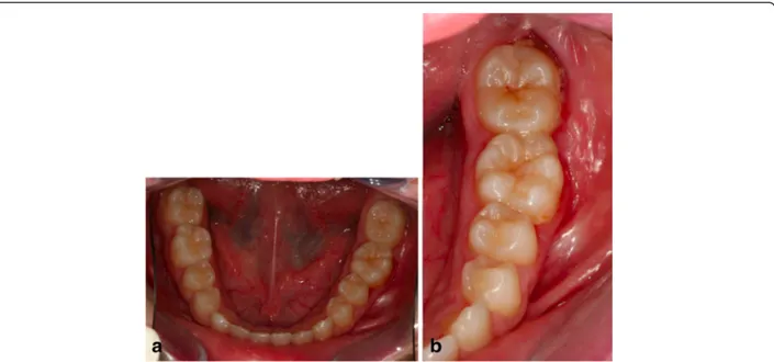 Figure 29 Intraoral photographs 1 year post-treatment. (a) lower occlusal view; (b) the treated teeth; no tooth morbidity is evident