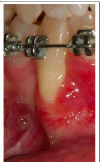 Figure 9 After 12 months. When the canine was present in the oral cavity (a), a bracket was bonded to it and linked directly to the arch by an elastic ligation