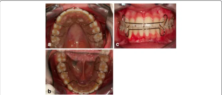 Figure 13 Retention was established with removable appliances on the upper arch (a) and the lower arch (b), to maintain the obtained result (c)