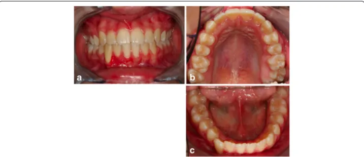 Figure 16 Post-treatment intraoral photographs: (a) frontal view; (b) upper occlusal view; (c) lower occlusal view