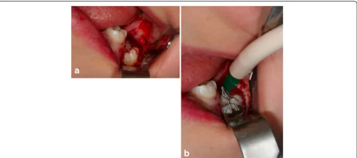Figure 21 Surgery (a) and placement of buttons (b). Two buttons were bonded on the molar crown in order to prevent the reopening of the surgical site in case one of the buttons came off accidentally during orthodontic treatment.
