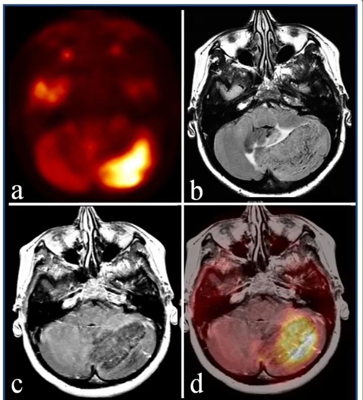 Figure 1 Axial positron emission tomography view. (a) Intense glucose metabolism in the left hemisphere of the cerebellum, corresponding to a hypointense and slightly enhancing area with (b) maximum diameter of 5 cm in axial T1-weighted post contrast view