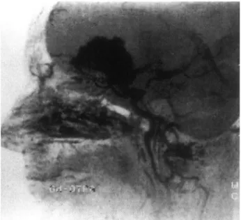 Figure 5. Angio-MRI of the same patient gives further details of the men ingioma.