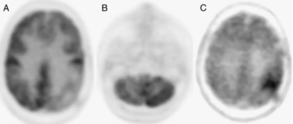 FIGURE 1. In a patient submitted 2 years before to surgical intervention in the left posterior parietal lobe and subsequent radiotherapy for a malignant glioma, axial 18 F-FDG PET view shows area of hypometabolism in the surgical site (A)