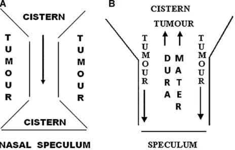 Fig. 1. (A) Drawing of possible precocious intraoperative empty sella during inadequate transsphenoidal removal of huge pituitary adenomas: if tumour removal starts with the intra- and suprasellar central parts of the adenoma, the suprasellar cisternal pla