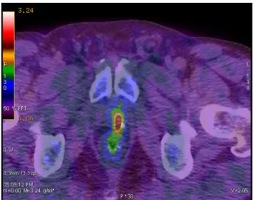 Fig. 2. F 18 choline fused PET-CT axial views show pathological uptake at the left level of the prostate bed in a case submitted to radical prostatectomy with biochemical progression (PSA = 1.5 ng/ml).