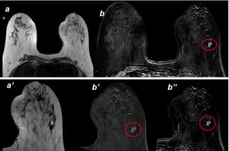 Fig. 4 a-a ’) Axial T2 MRI image: pre-cryoablation image with focal lesion spiculated margins inside the left breast b-b ’-b”) Axial T1 MRI image: