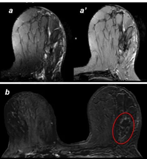 Fig. 6 MR images show visualization and segmentation of the cryoablation –induced lesion in three perpendicular planes (left to right: axial, sagittal, coronal)