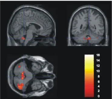 Fig. 2. Regions with signiﬁcantly decreased cerebral glucose metabolism in the post- post-cTBS versus pre-post-cTBS scans, measured with SPM2, represented on MRI template including inferior vermis (46, 68, 34) and bilaterally the inferior semilunar lobul