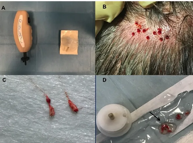 Figure 2. Micro-graft procedure phase 1. (A) On the left, Rigenera Securdrill device and on the right  Rigeneracons kit; (B) The holes in the scalp after punch biopsy; (C) Selected scalp tissues into the  strips (2 × 2 mm); (D) The authors controlled the p