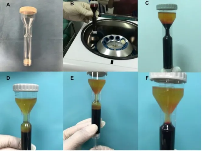 Figure 4.  i-Stem  platelet rich plasma (PRP) procedure. (A) Kit i-Stem; (B) The blood collected in  i-Stem Kit underwent at centrifugation; (C) The PRP and PPP suspension obtained by the system  after the first centrifugation; (D) The PRP and PPP after th