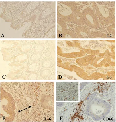 Figura  2.    Espressione  e  localizzazione  di  IL-6  nella  mucosa  sana  a  distanza  (A  e  C)  e  nel  tessuto  neoplastico  corrispondente  (B  e  D)  di  un  carinoma  moderatamente  differenziato  (B)  e  di  un  carcinoma  scarsamente differenzia