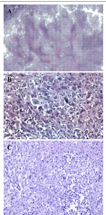 Figure 1 A) Histologically the tumor was composed of nodules of polygonal epithelioid and spindle cells circumscribe areas of central hyalinization and necrosis (H&amp;E, ×200)