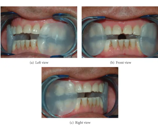 Figure 1: Soft monobloc mandibular advancement device (sMMAD).