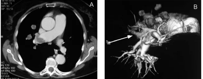 Figure 1. (A) Contrast-enhanced computed tomography revealing a mass in the right pulmonary artery with an intraluminal filling defect and 3 nodular masses appearing as opacities in the right pulmonary parenchyma