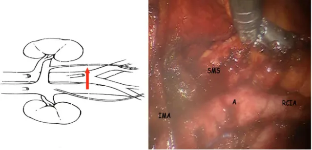 FIG. 4 SMS development. SMS submesenteric space, RCIA right common iliac artery, A aorta, IMA inferior mesenteric artery