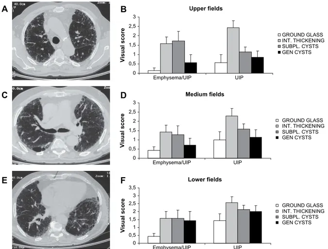 Figure 2 Typical HRCT scan of an emphysema/UIP patient. (A) Fibrotic reticular lesions, prevalently subpleural, and extended emphysema, are seen in the upper fields