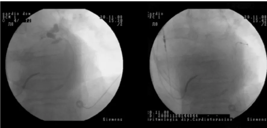 Figura 8. Piccola dissezione del seno coronarico che non ha compromesso il completamento della procedura di impianto.