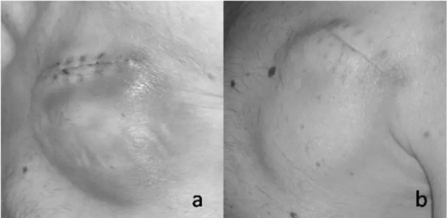 Figura 1. a: vistoso ematoma non dolente successivo alla sostituzione di defibrillatore impiantabile in portatore di protesi valvolare aortica meccani- meccani-ca; b: lo stesso paziente senza alcun intervento a distanza di 1 mese.