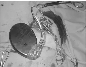 Figura 2. Sindrome di Twiddler: alla revisione chirurgica gli elettrocate- elettrocate-teri atriale e ventricolare risultano retratti e attorcigliati all’interno  del-la tasca.