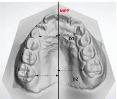 Figure 6. Median palate plane (MPP) drawn on digital maxillary dental arch. See also emi-linear  measurements as distance between the MPP and primary canines (D1) and permanent first molars  (D2) on both sides