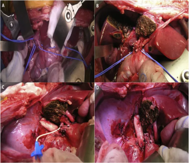 Fig. 3. Technical aspects of ante situm liver resection and inferior vena cava replacement.