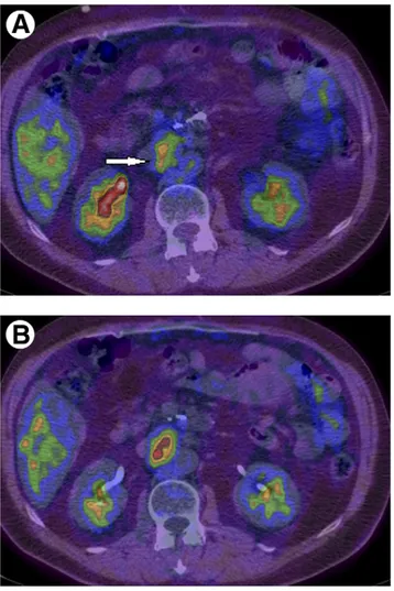 Figure 7 A 52-year-old male patient with previously resected pan- pan-creatic cancer. Early (60 minutes) PET/CT (A) shows a moderate FDG uptake in an enlarged abdominal lymph node (arrow, SUV 2.8), which increases in the delayed imaging (110 minutes, SUV 3