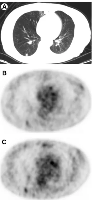 Figure 2 Dual-point fluorodeoxyglucose (FDG)-PET imaging of 67- 67-year-old woman with 0.9 cm solitary pulmonary nodule in the right lower lobe on CT (A)