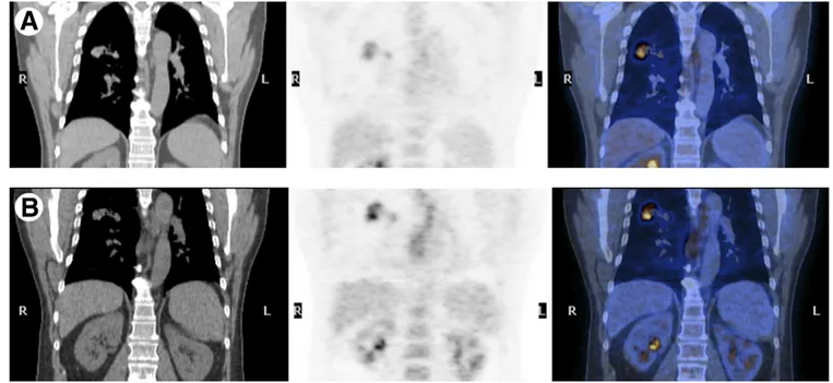 Figure 4 Coronal CT, PET, and PET/CT fusion images of a 58-years-old patient: early (A) and delayed (B) scans.