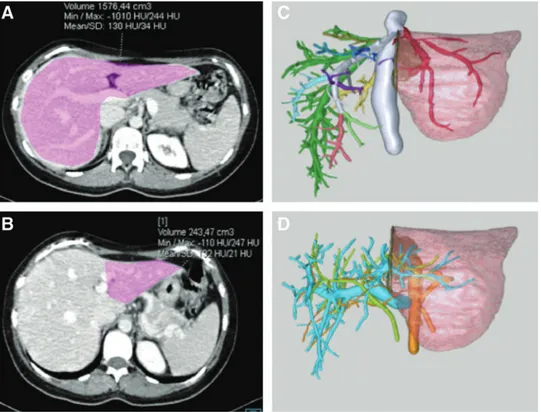 FIG. 1. Preoperative donor imaging of the liver. Preoperative donor’s CT scan showing the volumetry of (A) the whole liver and (B) the left lateral segment; three-dimensional reconstruction of (C) the hepatic vein outflow and (D) the portal vein, hepatic a