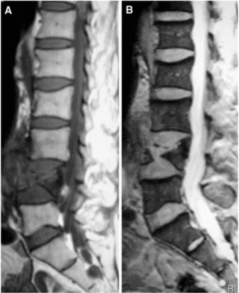 Fig. 1 Abdominal multislice computed tomography (msCT) msCT image shows an infrarenal AAA rupture with vertebral body erosion