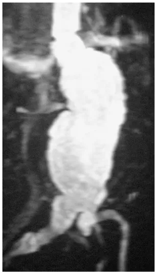 Fig. 4 T1-weighted/FFE/MIP (Maximum Intensity Projection) coro- coro-nal (TE 1.3, TR 17) MRI images