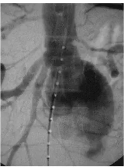 Fig. 6 Angiography after position of the endoprosthesis demon- demon-strates complete exclusion of the aneurysmatic sac