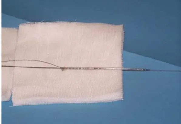 Fig. 3 View of the entire retrieved system comprised of the lost stent, the low-profile balloon, and the gooseneck microsnare