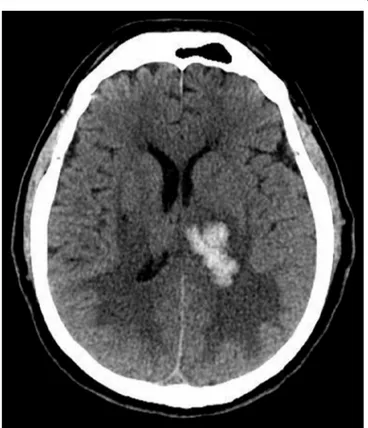 Figure 1: Cranial computed tomography scan: left thalamo-capsular  hematoma (38 cm max) with surrounding edema and mass effect upon the  left lateral ventricle.