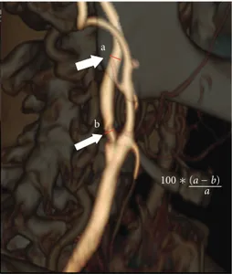 Figure 1: Volume rendering CT angiography showing measure- measure-ment of internal carotid artery stenosis