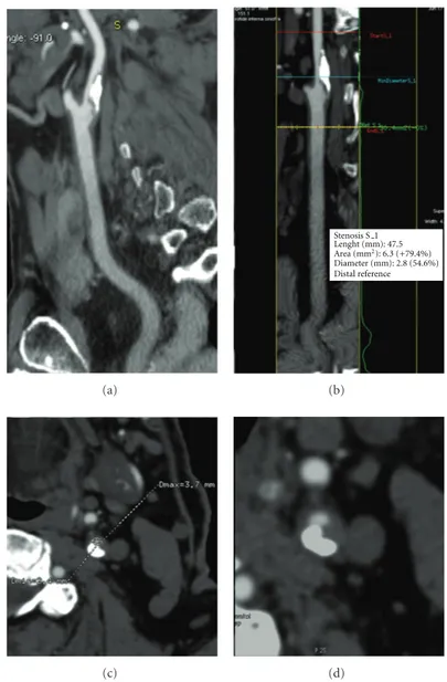 Figure 3: Left carotid stenosis demonstrated on CT angiography (CTA) (Case 1) with curved image (a) and lumen image produced by advanced vessel analysis (AVA) software (b)