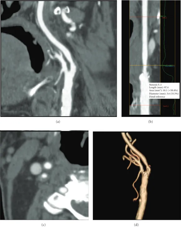 Figure 5: Right carotid stenosis demonstrated on CT angiography (CTA) (Case 2) with curved image (a) and lumen image produced by Advanced Vessel Analysis (AVA) software (b)