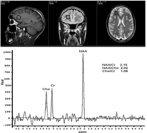 Figure 1. 1 H magnetic resonance scout image of a healthy volunteer showing the optimal positioning of the single voxel located adjacent to the cortical-subcortical junction, just anteriorly to the frontal horn of the lateral ventricle, at the same height 