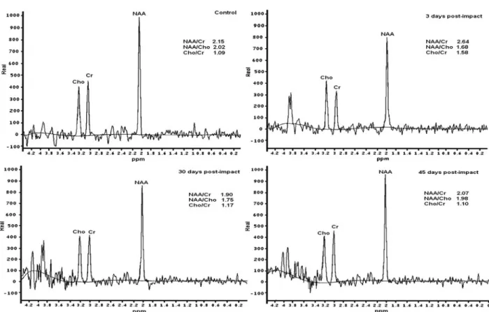 Figure 5. Representative 1 H magnetic resonance spectra recorded in a healthy control subject and in a concussed athlete at 3, 30, and 45 days postinjury (for graphical reasons, the 15-day spectrum was not reported)
