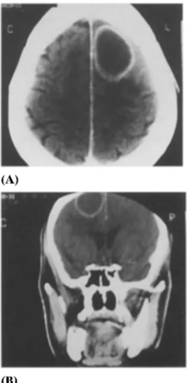 Figure L Cranio-cerebral contrast-enhanced  CT scan. The  axial view (A) and the coronal (B) reconstruction  show a  left  fronto-parietal abscess  with  ring  enhancement  and  perilesional edema