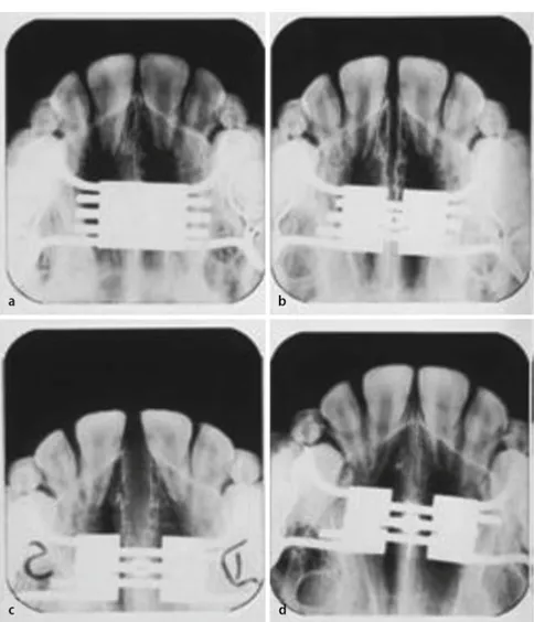 Fig. 5  8  CT Dentascan before and after opening of the midpalatal suture