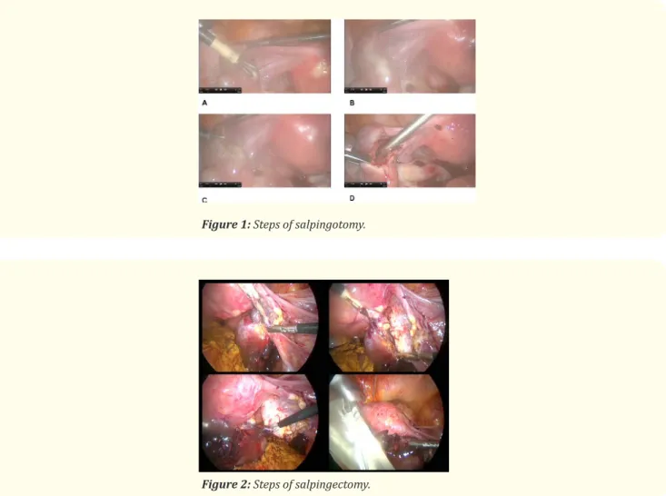 Figure 1: Steps of salpingotomy.