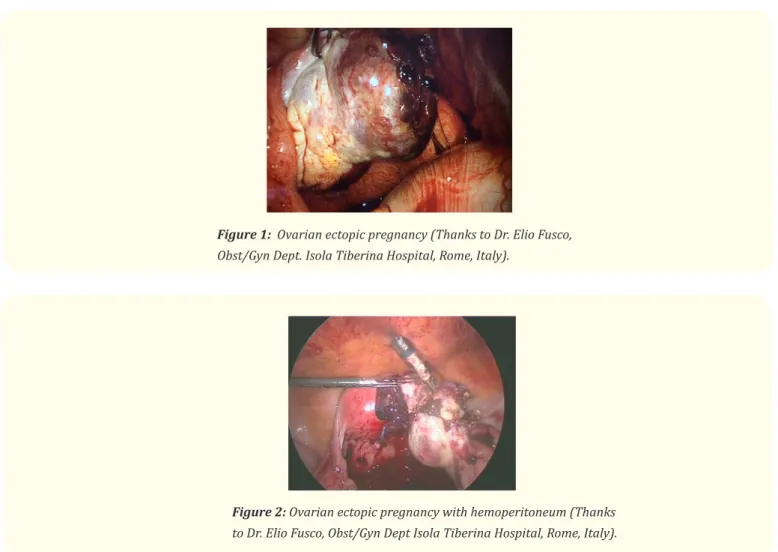 Figure 1:  Ovarian ectopic pregnancy (Thanks to Dr. Elio Fusco,  Obst/Gyn Dept. Isola Tiberina Hospital, Rome, Italy).