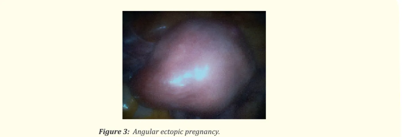 Figure 3:  Angular ectopic pregnancy.