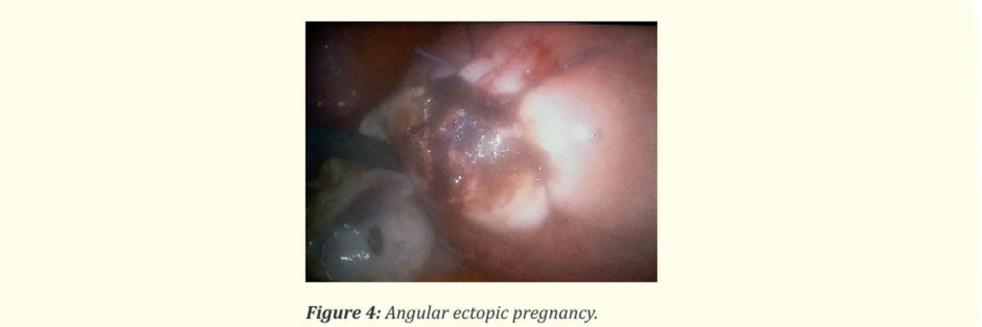 Figure 4: Angular ectopic pregnancy.